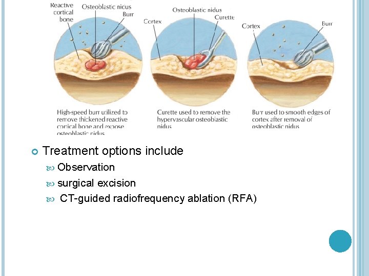  Treatment options include Observation surgical excision CT-guided radiofrequency ablation (RFA) 