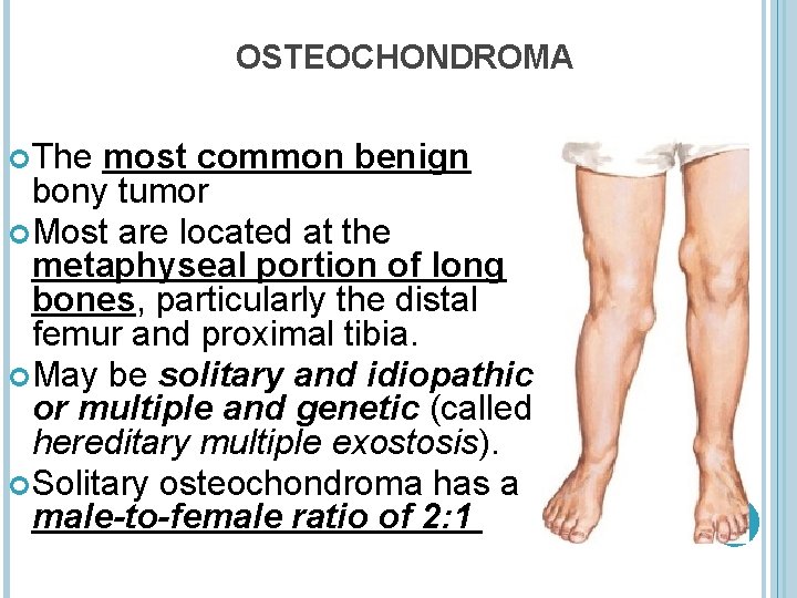 OSTEOCHONDROMA The most common benign bony tumor Most are located at the metaphyseal portion