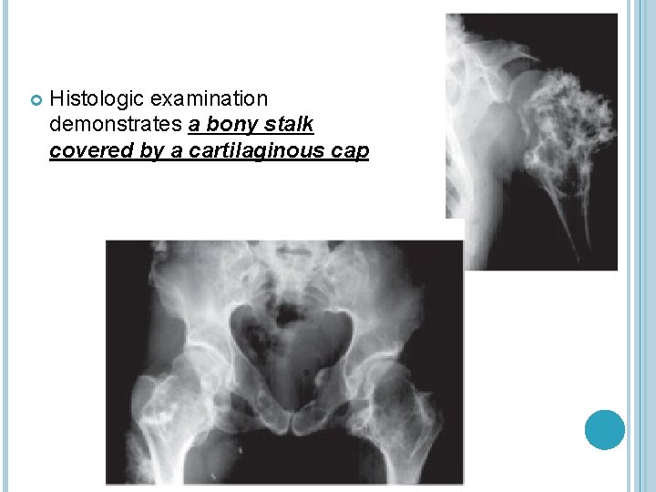  Histologic examination demonstrates a bony stalk covered by a cartilaginous cap 