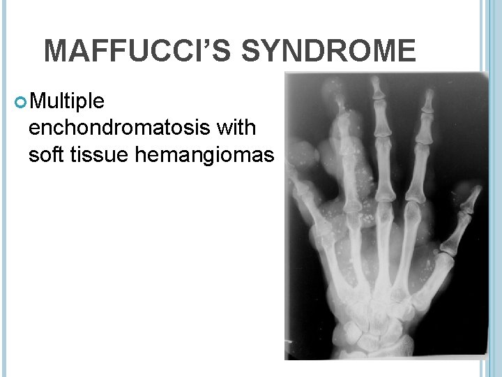 MAFFUCCI’S SYNDROME Multiple enchondromatosis with soft tissue hemangiomas 