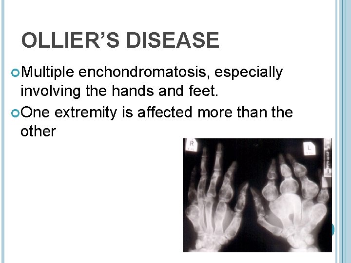 OLLIER’S DISEASE Multiple enchondromatosis, especially involving the hands and feet. One extremity is affected
