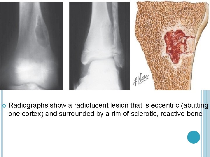  Radiographs show a radiolucent lesion that is eccentric (abutting one cortex) and surrounded