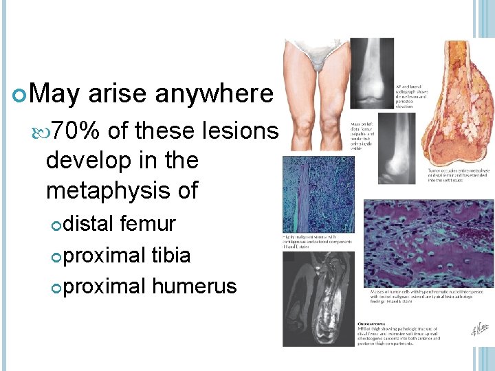  May arise anywhere 70% of these lesions develop in the metaphysis of distal