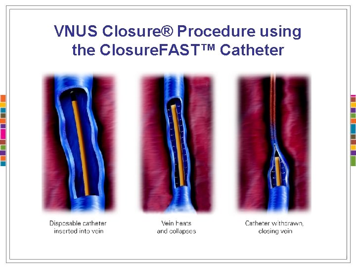 VNUS Closure® Procedure using the Closure. FAST™ Catheter 