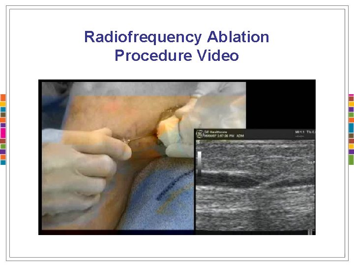 Radiofrequency Ablation Procedure Video 