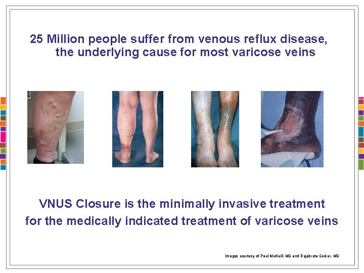 25 Million people suffer from venous reflux disease, the underlying cause for most varicose