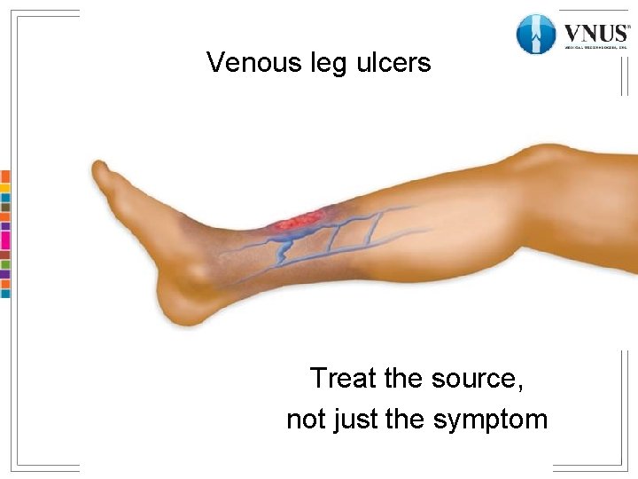 Venous leg ulcers Venous Ulcers Treat the source, not just the symptom 