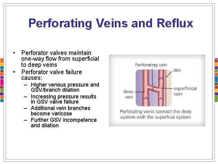 Perforating Veins and Reflux • Perforator valves maintain one-way flow from superficial to deep