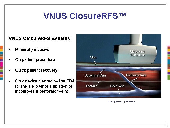 VNUS Closure. RFS™ VNUS Closure. RFS Benefits: • Minimally invasive • Outpatient procedure •