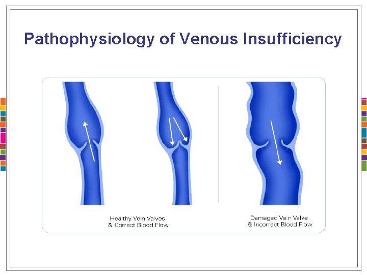 Pathophysiology of Venous Insufficiency 