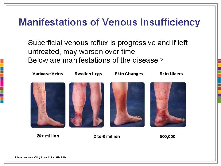 Manifestations of Venous Insufficiency Superficial venous reflux is progressive and if left untreated, may