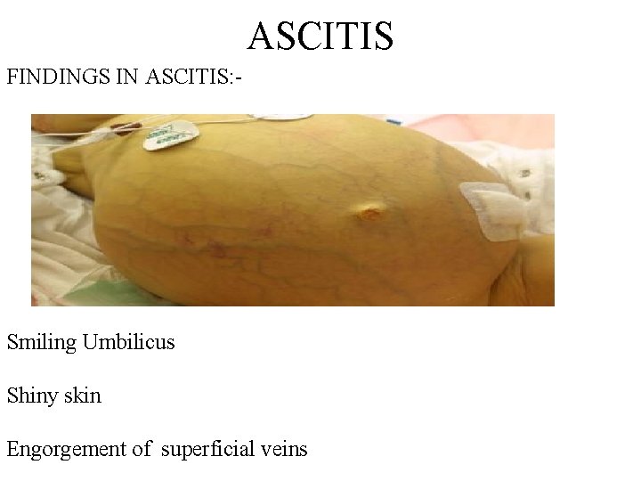 ASCITIS FINDINGS IN ASCITIS: - Smiling Umbilicus Shiny skin Engorgement of superficial veins 