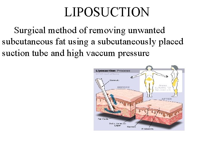 LIPOSUCTION Surgical method of removing unwanted subcutaneous fat using a subcutaneously placed suction tube