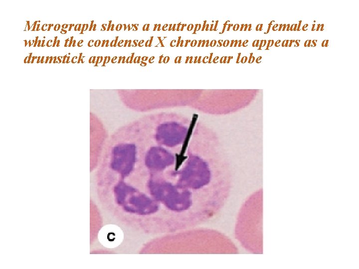 Micrograph shows a neutrophil from a female in which the condensed X chromosome appears