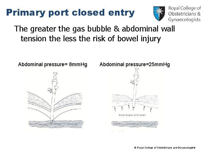 Primary port closed entry The greater the gas bubble & abdominal wall tension the