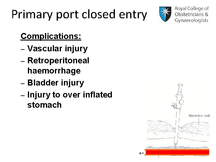 Primary port closed entry Complications: – Vascular injury – Retroperitoneal haemorrhage – Bladder injury