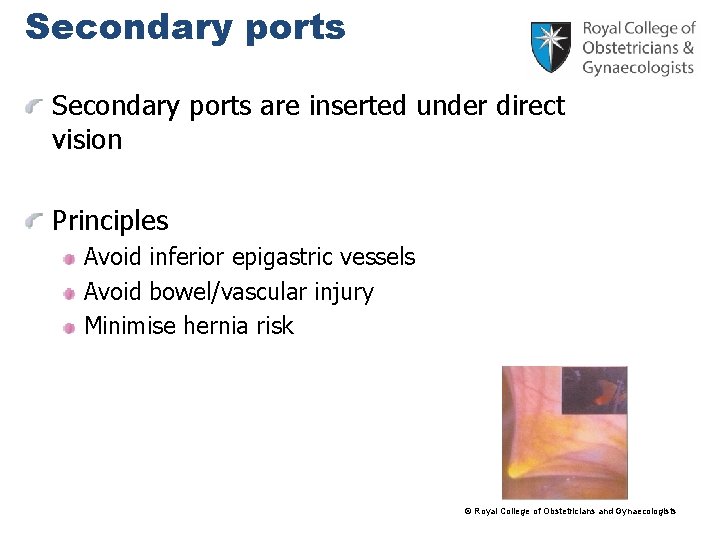 Secondary ports are inserted under direct vision Principles Avoid inferior epigastric vessels Avoid bowel/vascular