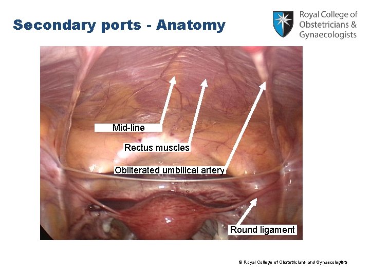 Secondary ports - Anatomy Mid-line Rectus muscles Obliterated umbilical artery Round ligament © Royal