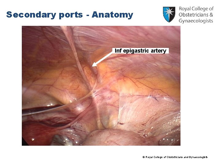 Secondary ports - Anatomy Inf epigastric artery © Royal College of Obstetricians and Gynaecologists