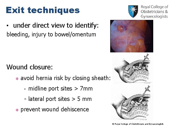 Exit techniques • under direct view to identify: bleeding, injury to bowel/omentum Wound closure: