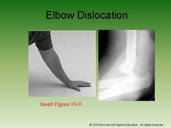 Elbow Dislocation Insert Figure 19 -9 © 2010 Mc. Graw-Hill Higher Education. All rights