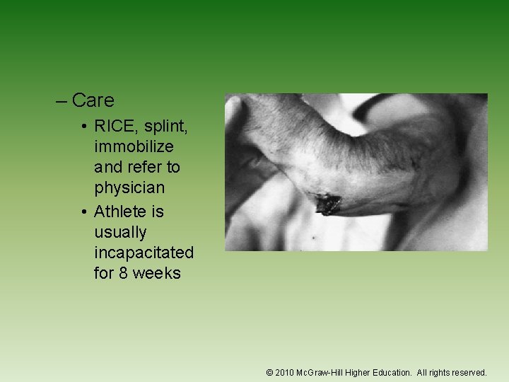 – Care • RICE, splint, immobilize and refer to physician • Athlete is usually