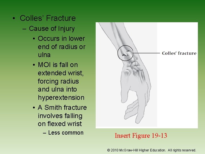  • Colles’ Fracture – Cause of Injury • Occurs in lower end of