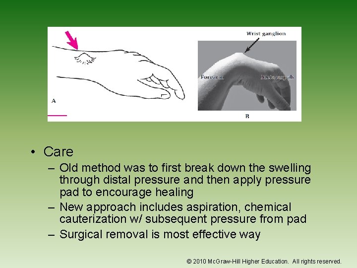  • Care – Old method was to first break down the swelling through