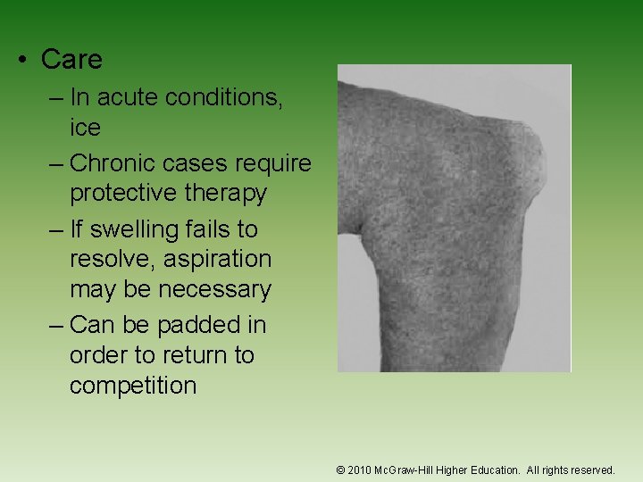  • Care – In acute conditions, ice – Chronic cases require protective therapy