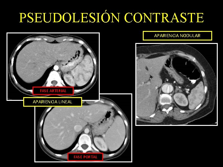 PSEUDOLESIÓN CONTRASTE APARIENCIA NODULAR FASE ARTERIAL APARIENCIA LINEAL FASE PORTAL 