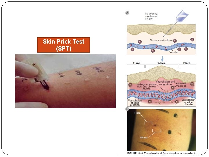 Skin Prick Test (SPT) 