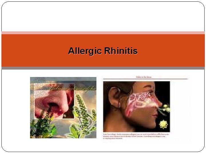 Allergic Rhinitis 