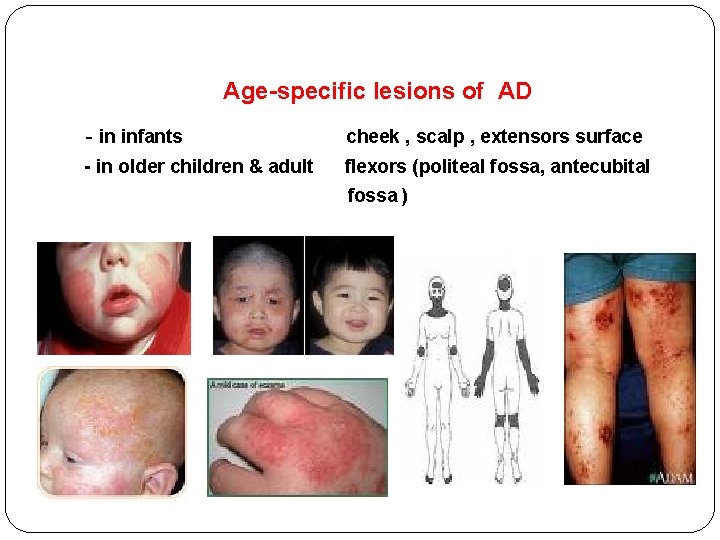 Age-specific lesions of AD - in infants cheek , scalp , extensors surface -