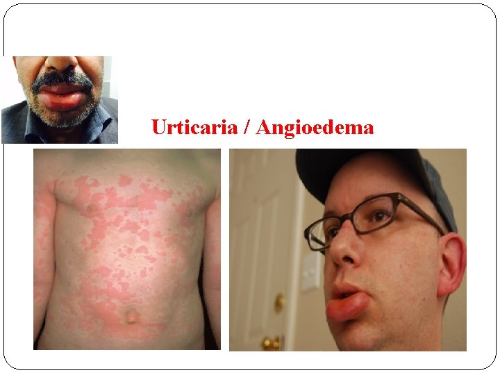 Urticaria / Angioedema 