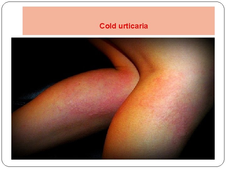 Cold urticaria 