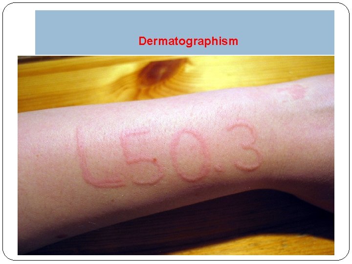 Dermatographism 