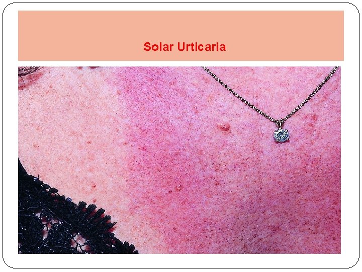 Solar Urticaria 