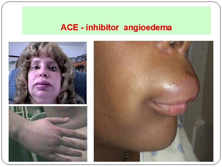 ACE - inhibitor angioedema 