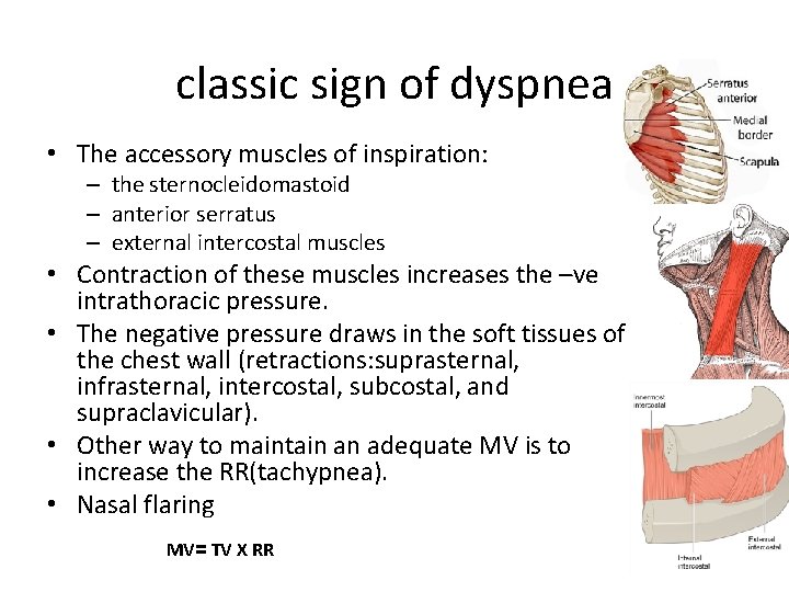 classic sign of dyspnea • The accessory muscles of inspiration: – the sternocleidomastoid –