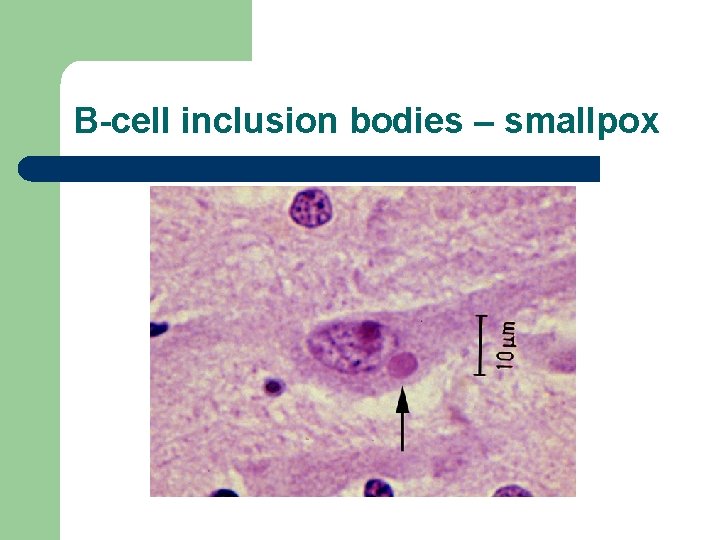 B-cell inclusion bodies – smallpox 