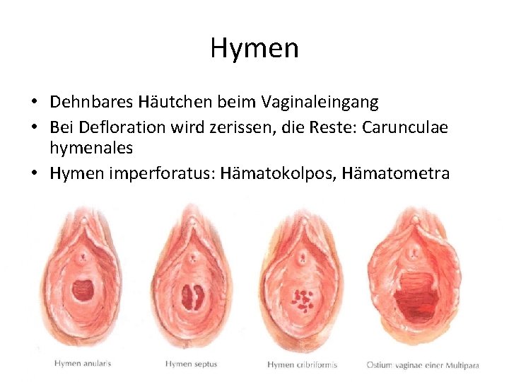 Hymen • Dehnbares Häutchen beim Vaginaleingang • Bei Defloration wird zerissen, die Reste: Carunculae