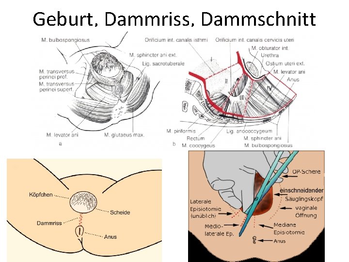 Geburt, Dammriss, Dammschnitt 