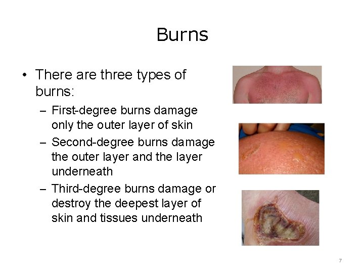 Burns • There are three types of burns: – First-degree burns damage only the