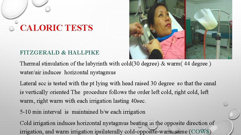 CALORIC TESTS FITZGERALD & HALLPIKE Thermal stimulation of the labyrinth with cold(30 degree) &