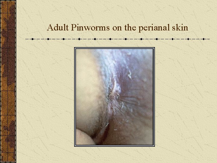 Adult Pinworms on the perianal skin 