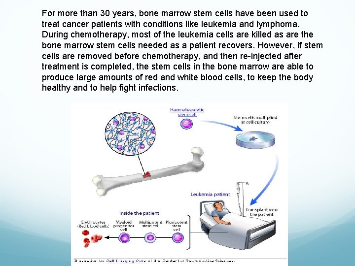 For more than 30 years, bone marrow stem cells have been used to treat