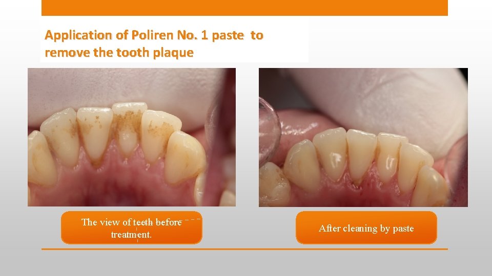 Application of Poliren No. 1 paste to remove the tooth plaque The view of