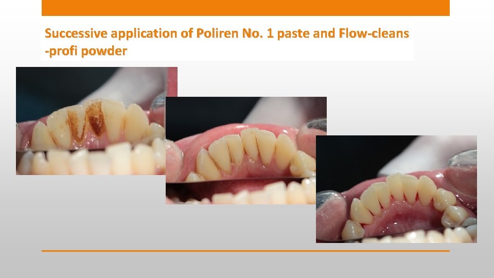 Successive application of Poliren No. 1 paste and Flow-cleans -profi powder 