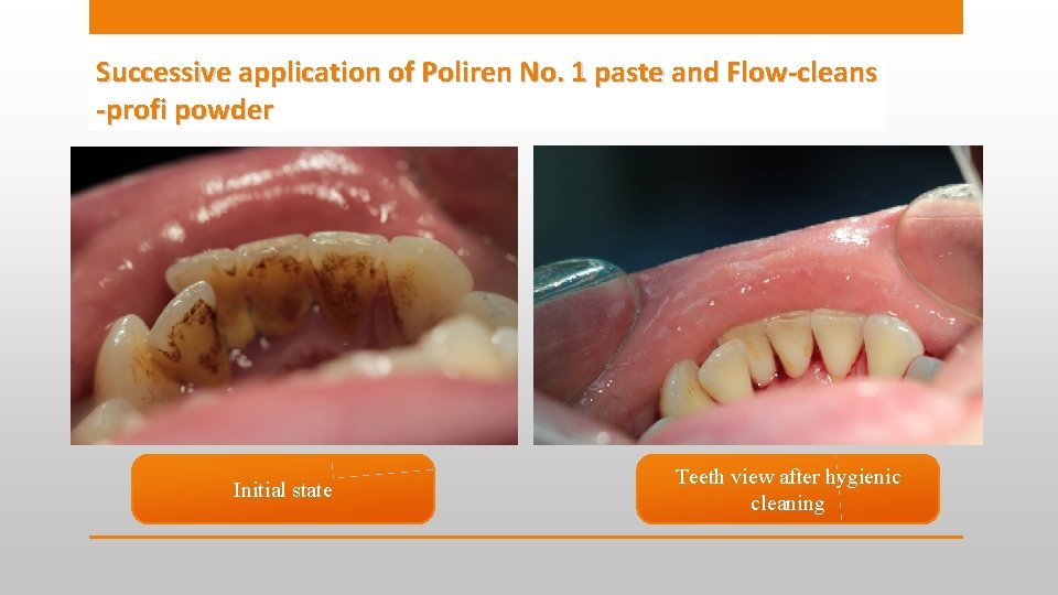 Successive application of Poliren No. 1 paste and Flow-cleans -profi powder Initial state Teeth