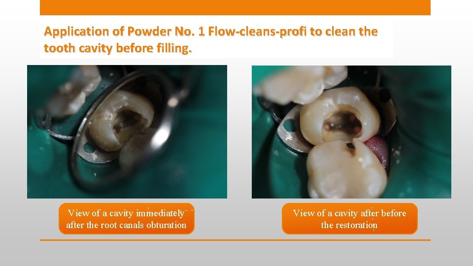 Application of Powder No. 1 Flow-cleans-profi to clean the tooth cavity before filling. View